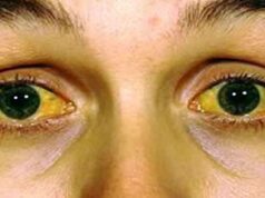 ሕማም ፀላም ከብዲ /hepatitis/