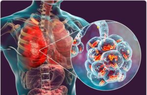 ኣብ ትግራይ ብሰንኪ ሕማም ኒሞኒያ ቍፅሪ ዝሞቱ ህፃናት ይውስኽ ኣሎ፡፡