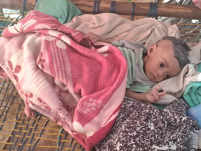 Kahsay Never Felt Her Mother’s Touch; Now Hunger Threatens Her Life at Adi Mohammeday IDP Camp in Northwestern # Tigray